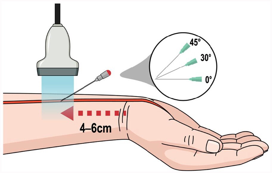 TRACK NEEDLE (Introducer Puncture Needle) - Image 7
